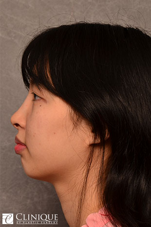 Chin Augmentation w/Implant, Genioplasty Clinique of Plastic Surgery St. Pete