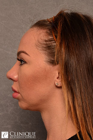 Chin Augmentation, Genioplasty Clinique of Plastic Surgery St. Petersburg