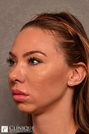 Chin Augmentation, Genioplasty Clinique of Plastic Surgery St. Petersburg