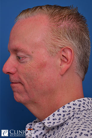 Chin Augmentation, Genioplasty, Neck Plication Clinique of Plastic Surgery St. Pete