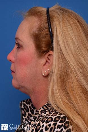 Chin Augmentation, Genioplasty Clinique of Plastic Surgery St. Petersburg