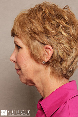 Chin Augmentation, Genioplasty, Neck Plication Clinique of Plastic Surgery St. Petersburg