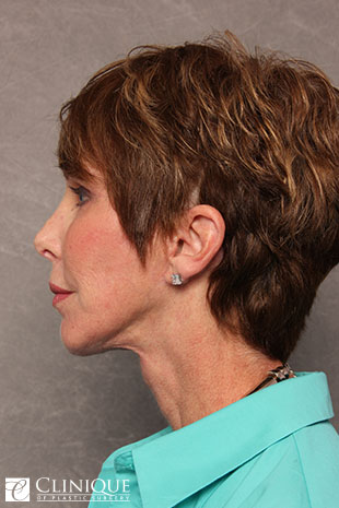 Chin Augmentation, Genioplasty, Neck Plication