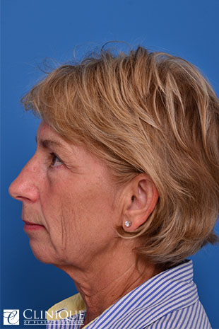 Chin Augmentation, Genioplasty Clinique of Plastic Surgery St. Petersburg