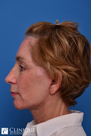 Chin Augmentation, Genioplasty Clinique of Plastic Surgery St. Petersburg