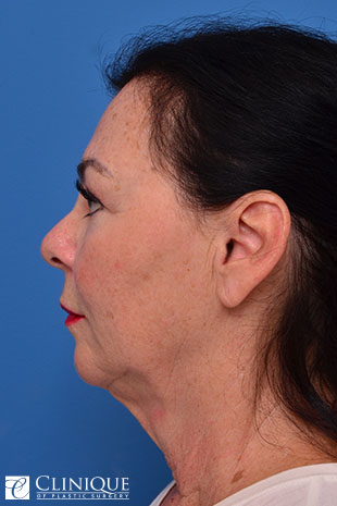 Chin Augmentation, Genioplasty, Neck Plication Clinique of Plastic Surgery St. Pete