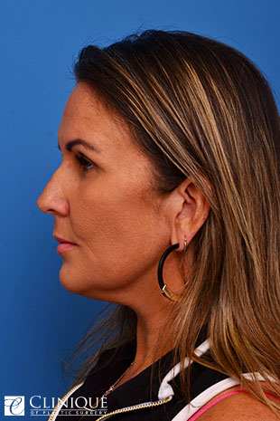 Neck Plication & Defatting Clinique of Plastic Surgery St. Pete
