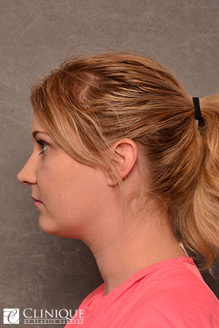 Neck Plication & Defatting Clinique of Plastic Surgery St. Pete