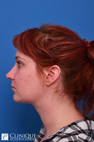 Neck Plication & Defatting Clinique of Plastic Surgery St. Pete