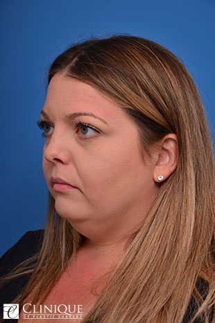 Neck Plication & Defatting, Buccal Fat Pad Removal Clinique of Plastic Surgery St. Pete rsburg