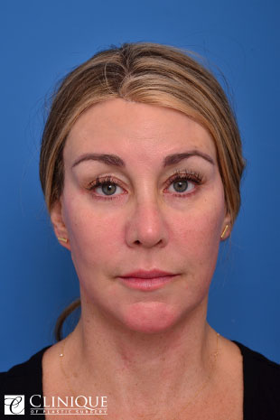 Rhinoplasty (nose job) with Tipplasty Clinique of Plastic Surgery St. Pete