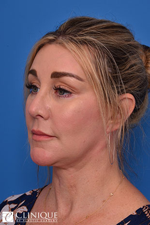 Rhinoplasty (nose job) with Tipplasty Clinique of Plastic Surgery St. Pete
