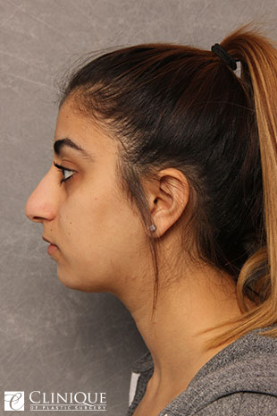Rhinoplasty (nose job) with Tipplasty Clinique of Plastic Surgery St. Pete