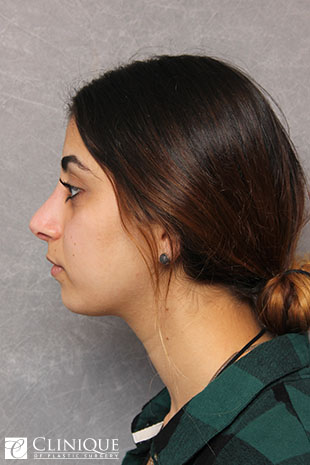 Rhinoplasty (nose job) with Tipplasty Clinique of Plastic Surgery St. Pete