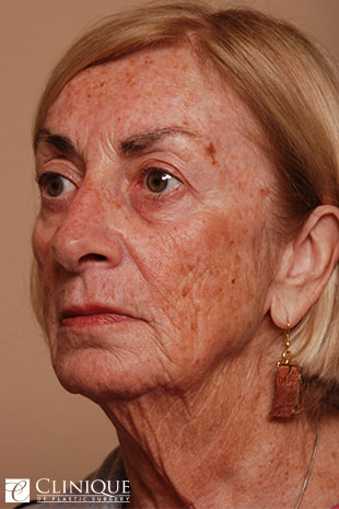 RefresherLift℠, Facelift, Neck Plication (Neck Lift), Upper & Lower Eyelid Blepharoplasty Clinique of Plastic Surgery St. Petersburg