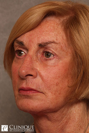RefresherLift℠, Facelift, Neck Plication (Neck Lift), Upper & Lower Eyelid Blepharoplasty Clinique of Plastic Surgery St. Petersburg