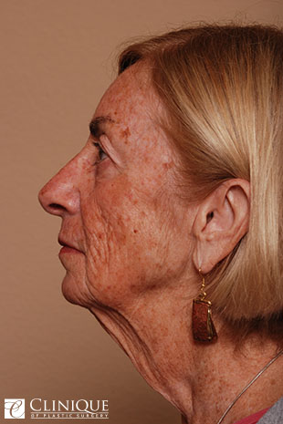 RefresherLift℠, Facelift, Neck Plication (Neck Lift), Upper & Lower Eyelid Blepharoplasty Clinique of Plastic Surgery St. Petersburg