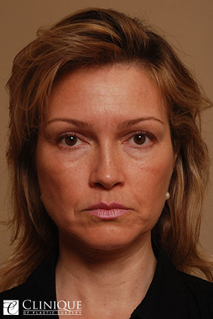 RefresherLift℠, Facelift, Neck Plication (Neck Lift), Lower Lid Blepharoplasty, Fat Transfer to Cheeks & Lips Clinique of Plastic Surgery St. Pete