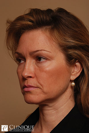 RefresherLift℠, Facelift, Neck Plication (Neck Lift), Lower Lid Blepharoplasty, Fat Transfer to Cheeks & Lips Clinique of Plastic Surgery St. Pete