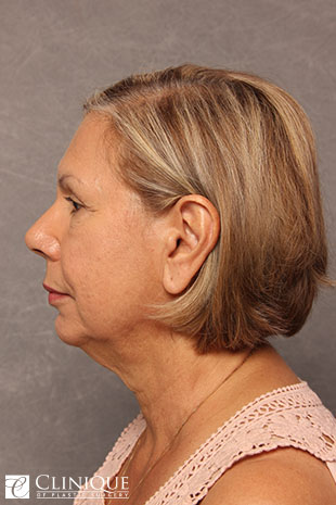 RefresherLift℠, Facelift, Neck Plication (Neck Lift), Lower Lid Blepharoplasty, Dual Plane℠ Brow Lift, Fat Transfer to Cheeks & Brow, Controlled Depth Peel Clinique of Plastic Surgery St. Petersburg