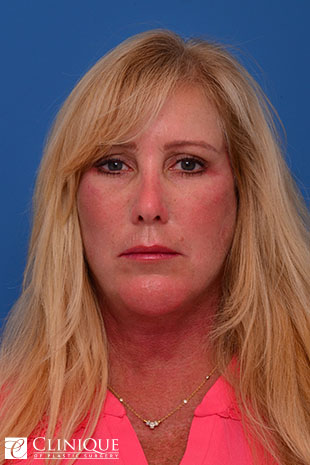 RefresherLift℠, Facelift, Neck Plication (Neck Lift), Genioplasty, Malar Augmentation w/Implants, Buccal Fat Pad Removal Clinique of Plastic Surgery St. Pete