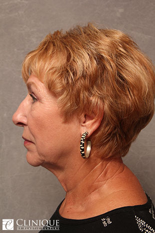 RefresherLift℠, Facelift, Neck Plication (Neck Lift), Lower Lid Blepharoplasty, Fat Transfer to Cheeks, Temple & Nasolabial Folds Clinique of Plastic Surgery St. Petersburg RefresherLift℠, Facelift, Neck Plication (Neck Lift), Lower Lid Blepharoplasty, Fat Transfer to Cheeks, Temple & Nasolabial Folds Clinique of Plastic Surgery St. Petersburg