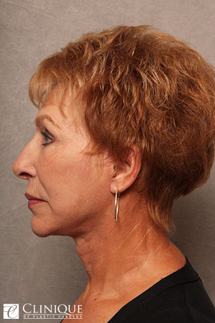 RefresherLift℠, Facelift, Neck Plication (Neck Lift), Lower Lid Blepharoplasty, Fat Transfer to Cheeks, Temple & Nasolabial Folds Clinique of Plastic Surgery St. Petersburg RefresherLift℠, Facelift, Neck Plication (Neck Lift), Lower Lid Blepharoplasty, Fat Transfer to Cheeks, Temple & Nasolabial Folds Clinique of Plastic Surgery St. Petersburg