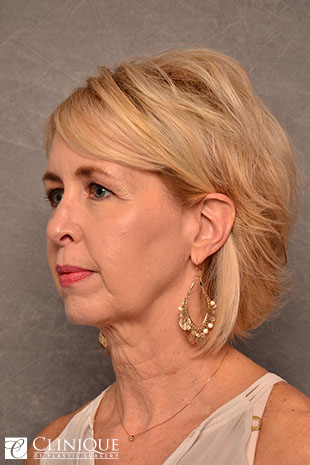 RefresherLift℠, Facelift, Neck Plication (Neck Lift), Lower Lid Blepharoplasty, TCA Peel Peri-Orbital Clinique of Plastic Surgery St. Petersburg