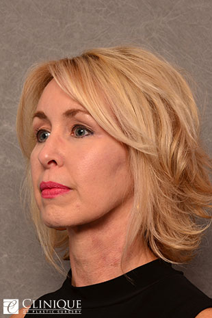 RefresherLift℠, Facelift, Neck Plication (Neck Lift), Lower Lid Blepharoplasty, TCA Peel Peri-Orbital Clinique of Plastic Surgery St. Petersburg