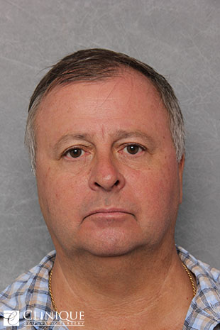 RefresherLift℠, Facelift, Neck Plication (Neck Lift), Fat Transfer to Cheeks Clinique of Plastic Surgery St. Pete