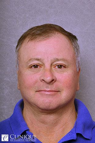 RefresherLift℠, Facelift, Neck Plication (Neck Lift), Fat Transfer to Cheeks Clinique of Plastic Surgery St. Pete