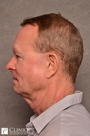 RefresherLift℠, Facelift, Neck Plication (Neck Lift), Inner Brow Lift, Upper & Lower Blepharoplasty Clinique of Plastic Surgery St. Pete