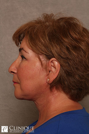 RefresherLift℠, Facelift, Neck Plication (Neck Lift), Lower Blepharoplasty, Fat Transfer to Cheeks & Lips, TCA Peel Peri-Orbital Clinique of Plastic Surgery St. Pete