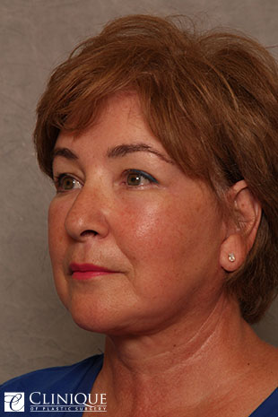 RefresherLift℠, Facelift, Neck Plication (Neck Lift), Lower Blepharoplasty, Fat Transfer to Cheeks & Lips, TCA Peel Peri-Orbital Clinique of Plastic Surgery St. Pete