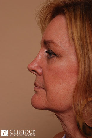 RefresherLift℠, Facelift, Neck Plication (Neck Lift), Dual Plane℠ Brow Lift, Fat Transfer to Cheeks & Lips Clinique of Plastic Surgery St. Petersburg RefresherLift℠, Facelift, Neck Plication (Neck Lift), Dual Plane℠ Brow Lift, Fat Transfer to Cheeks & Lips Clinique of Plastic Surgery St. Petersburg