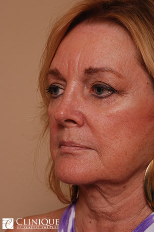 RefresherLift℠, Facelift, Neck Plication (Neck Lift), Dual Plane℠ Brow Lift, Fat Transfer to Cheeks & Lips Clinique of Plastic Surgery St. Petersburg RefresherLift℠, Facelift, Neck Plication (Neck Lift), Dual Plane℠ Brow Lift, Fat Transfer to Cheeks & Lips Clinique of Plastic Surgery St. Petersburg