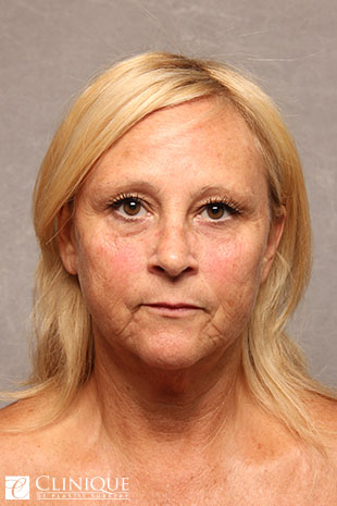 RefresherLift℠, Facelift, Neck Plication (Neck Lift), Dual Plane℠ Brow Lift, Lower Lid Blepharoplasty, Fat Transfer to Cheeks & Lips Clinique of Plastic Surgery St. Pete