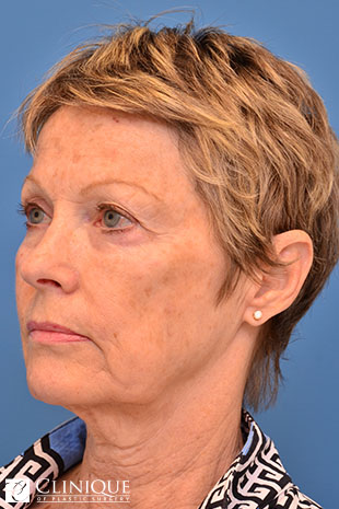 RefresherLift℠, Facelift, Neck Plication (Neck Lift), Temporal Lift, Controlled Depth Peel, Fat Transfer to Cheeks, Lips & Brow Clinique of Plastic Surgery St. Petersburg