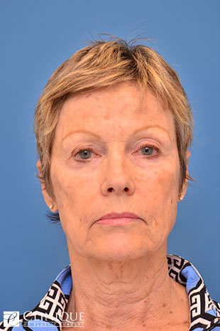RefresherLift℠, Facelift, Neck Plication (Neck Lift), Temporal Lift, Controlled Depth Peel, Fat Transfer to Cheeks, Lips & Brow Clinique of Plastic Surgery St. Petersburg
