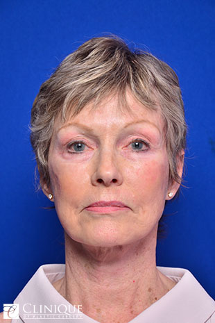 RefresherLift℠, Facelift, Neck Plication (Neck Lift), Temporal Lift, Controlled Depth Peel, Fat Transfer to Cheeks, Lips & Brow Clinique of Plastic Surgery St. Petersburg
