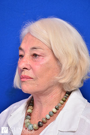 RefresherLift℠, Facelift, Neck Plication (Neck Lift), Temporal Lift, Fat Transfer to Lips, Lower Lid Fat Pad Extraction Clinique of Plastic Surgery St. Pete