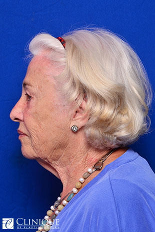 RefresherLift℠, Facelift, Neck Plication (Neck Lift), Temporal Lift, Fat Transfer to Lips, Lower Lid Fat Pad Extraction Clinique of Plastic Surgery St. Pete