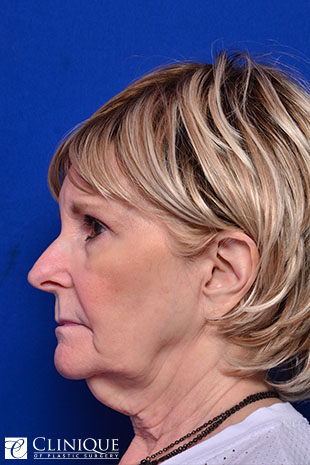 RefresherLift℠, Facelift, Neck Plication (Neck Lift), Temporal Brow Lift, Fat Transfer to Cheeks, Brow, Lips & TemplesClinique of Plastic Surgery St. Pete