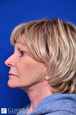 RefresherLift℠, Facelift, Neck Plication (Neck Lift), Temporal Brow Lift, Fat Transfer to Cheeks, Brow, Lips & TemplesClinique of Plastic Surgery St. Pete