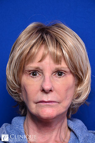 RefresherLift℠, Facelift, Neck Plication (Neck Lift), Temporal Brow Lift, Fat Transfer to Cheeks, Brow, Lips & TemplesClinique of Plastic Surgery St. Pete